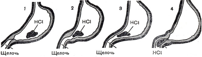 Рис. 53. Переход содержимого желудка в двенадцатиперстную кишку (схема)