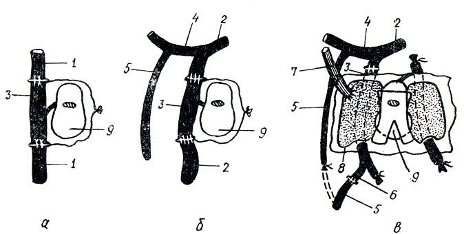 . 23.      :  -  ;  -  ;  -   : 1 - A. brachialis; 2 - A. profunda femoris; 3 - A. carotis interna; 4 - A. circumflexa femoris lateralis; 5 - Ramus descendens arteriae circumflexae femoris lateralis; 6 - A. cerebri media; 7 - V. saphena magna; 8 - Sinus cavernosus; 9 - Hypophisis