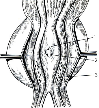 Рис. 21. Задняя стенка предстательного отдела мочеиспускательного канала. 1 - маточка семенного бугорка; 2 - отверстия семявыбрасывающих протоков; 3 - отверстия выводных протоков предстательной железы