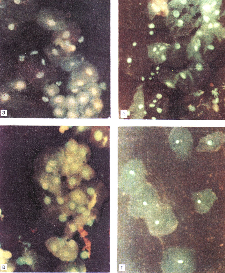 Рис. 26. Люминесцентная микроскопия мазков из ладьевидной ямки. (К стр. 81). Флюорохром акридин оранжевый в разведении 1: : 30ООО. X 200. а - мальчика Б., 6 лет (присутствуют парабазальные и базальные клетки (резкая А.Н.- реакция II); б - мужчины В., 27 лет (реакция IV - нормальный гормональный фон; преобладают клетки поверхностного слоя); в - больного П., 24 лет (реакция III - преобладают клетки нижних рядов поверхностного слоя и промежуточные клетки); г - больного Г., 58 лет (реакция II - I - клетки верхних рядов поверхностного слоя)
