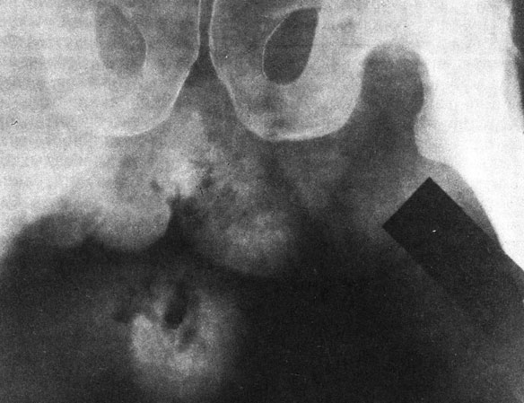 Рис. 33. Обзорная рентгенограмма таза и мошонки. Г ангрена Фурнье, виден газ в увеличенной мошонке