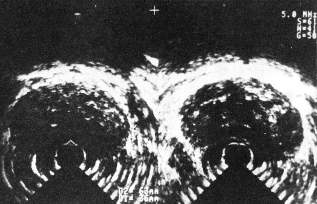 Рис. 40. Трансректальная горизонтальная ультрасонотомограмма аденомы предстательной железы. утолщена, полулунная, симметричная, размеры ее увеличены. Капсулярное эхо утолщено, непрерывное, внутреннее эхо усилено
