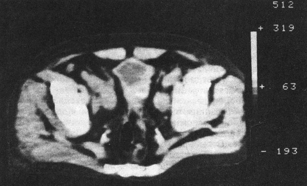 Рис. 45. Компьютерная рентгенограмма при РПЖ с прорастанием в окружающие ткани