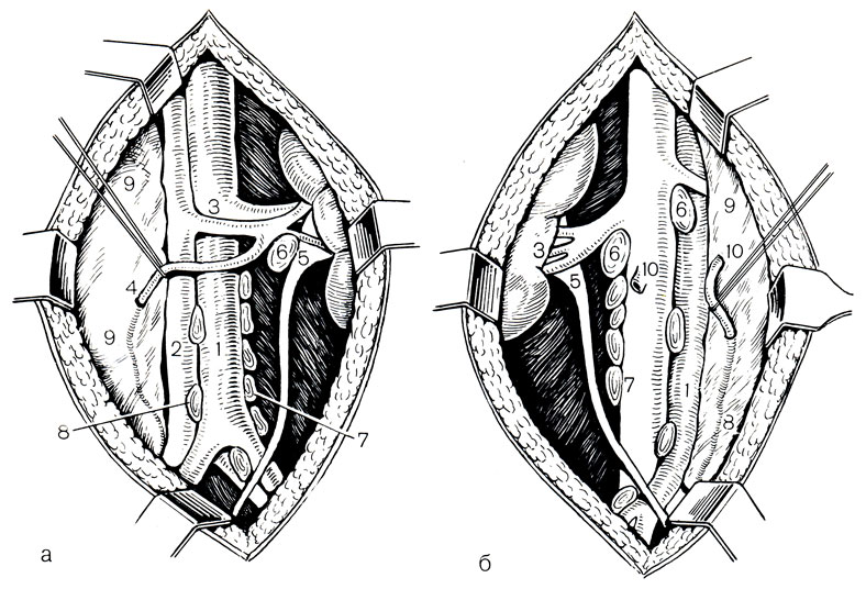 Рис. 48. Операция Шевассю. а - слева; б - справа. 1 - аорта; 2 - нижняя полая вена; 3 - почечная вена; 4 - яичковая вена; 5 - мочеточник; 6,7,8 - лимфатические узлы; 9 - париетальная брюшина; 10 - яичковая вена отсечена от нижней половой вены