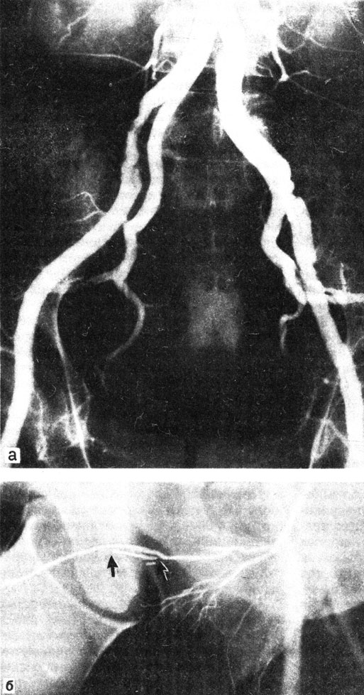 Рис. 61. Атеросклеротическое поражение подвоздошных артерий (а). Облитерация глубокой артерии полового члена (б)