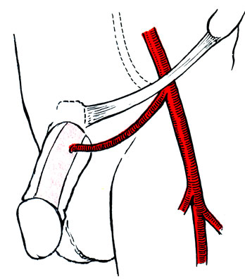 Рис. 62. Схема операции артериокавернозного шунтирования
