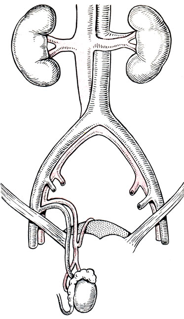 Рис. 68. Схема пересадки яичка с расположением трансплантата в мошонке