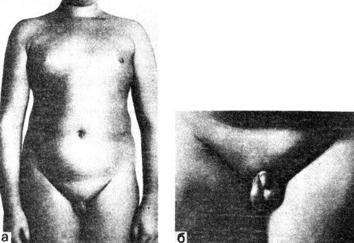 Рис. 71. Мальчик С, 14 лет, с задержкой полового развития II формы - с ложной адипозогенитальной дистрофией