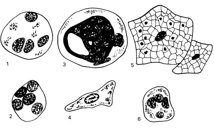 Рис. 75. Добавочные клетки эякулята. 1 - макрофаг; 2 - микрофаг; 3 - спермиофаг; 4 - клетки Сертоли; 5 - клетки эпителия; 6 - лейкоцит