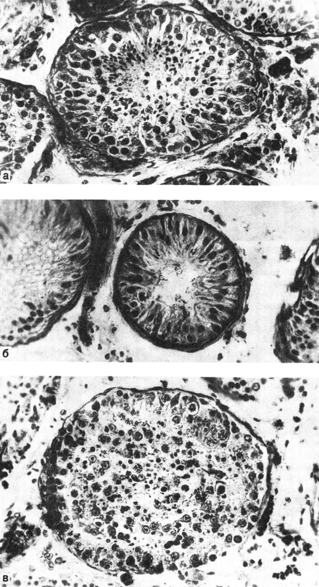 Рис. 78. Гистологическая картина (X 400). а - нормальная гистологическая картина (зрелые сперматозоиды в просвете канальцев); б - терминальная аплазия (генеративный эпителий отсутствует); в - картина торможения сперматогенеза на стадии сперматид