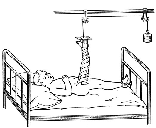 Рис. 15. Вертикальное клеевое вытяжение при переломе бедра у ребенка