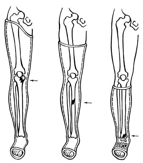Рис. 21. Гипсовая повязка при переломах костей голени и стопы в зависимости от уровня перелома