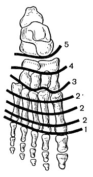 Рис. 23. Схема уровней ампутаций на стопе. 1 - по Гаранжо; 2 - по Шарп; 3 - по Лисфранку; 4 - по Бона - Иегеру; 5 - по Шопару
