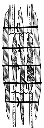 Рис. 32. Схема трансплантации по типу 'вязанки хвороста' по М. В. Волкову