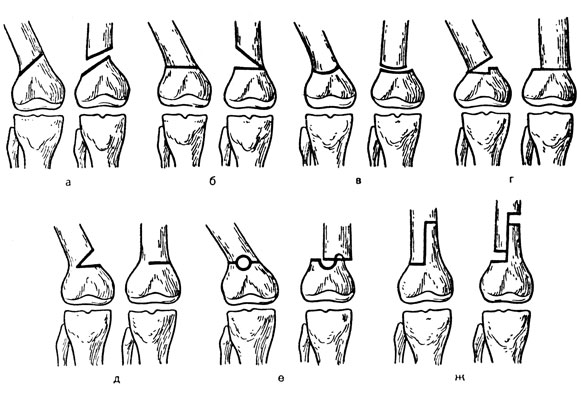 Рис. 36. Виды остеотомии. а - косая; б - поперечная; в - дугообразная; г - клиновидная с шипом; д - неполная клиновидная; е - окончатая; ж - Z-образная