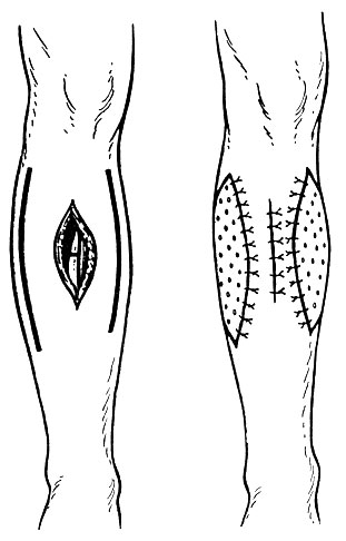 Рис. 41. Вариант комбинированной кожной аутопластики при закрытии раневого дефекта в верхней трети голени