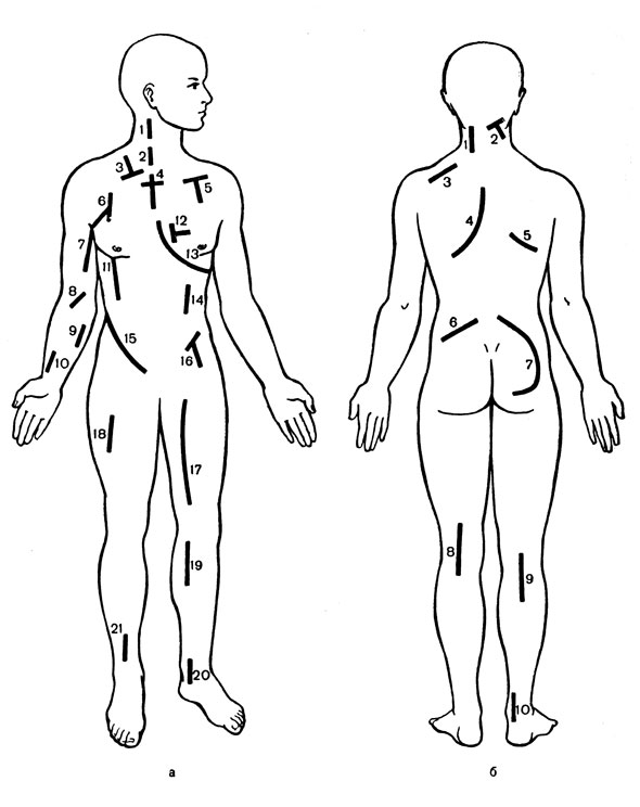 Рис. 43. Разрезы для доступа к крупным сосудам при ранениях на передней (а) и задней (б) поверхности туловища и конечностей. 1 - к внутренней сонной артерии; 2 - к общей сонной артерии; 3 - к позвоночной артерии; 4, 5 - к подключичным сосудам; 6 - к подкрыльцовым сосудам; 7 - к плечевой артерии; 8 - к сосудам локтевого сгиба; 9 - к локтевой артерии; 10 - к лучевой артерии; 11 - к продольной артерии груди; 12 - к внутренней сосковой артерии; 13 - к дуге аорты; 14 - к надчревной артерии: 15 - к общей подвздошной и под чревной артериям; 16 - к наружной подвздошной и бедренной артериям; 17 - к бедренным сосудам; 18 - к глубокой бедренной артерии; 19, 20 - к задней большеберцовой артерии; 21-к передней большеберцовой артерии; б: 1 - к затылочной артерии; 2 - к верхнему отделу позвоночной артерии; 3, 4, 5 - к лопаточным сосудам; 6, 7 - к ягодичным артериям; 8 - к подколенной артерии. 9,  10 - к задней большеберцовой артерии