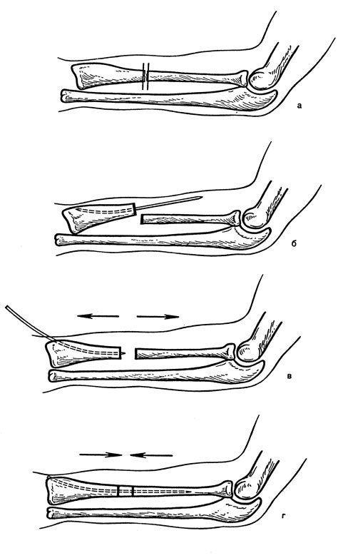 Рис. 73. Операция при застарелом переломовывихе предплечья типа Галеацпи. а - схема повреждения; б - металлический стержень введен в костномозговой канал периферического отломка; в - отломки лучевой кости растянуты аппаратом до выравнивания с локтевой костью; г - межкостный диастаз замещен трансплантатом, который плотно удерживается на стержне вследствие аутокомпрессии, вывих головки устранен