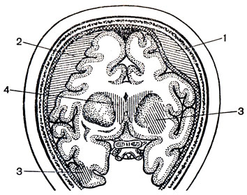 Рис. 85. Соотношение внутричерепных гематом с оболочками и веществом мозга. 1 - эпидуральная гематома; 2 - субдуральная гематома; 3 - внутримозговая гематома; 4 - внутрижелудочковая гематома