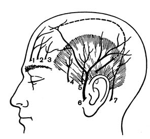 Рис. 87. Задний косой разрез мягких покровов головы для наложения фрезевого отверстия при подозрении на формирование внутричерепной гематомы в теменно-височной области (обозначения те же, что и на рис. 86)