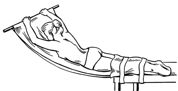 Рис. 88. Одномоментная репозиция при компрессионном переломе тела позвонка на гамаке Казакевича