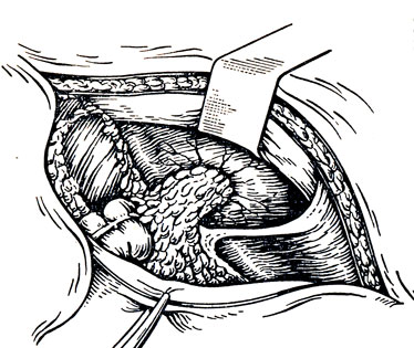 Рис. 95. Ушивание разрыва печени с подшиванием сальника на ножке